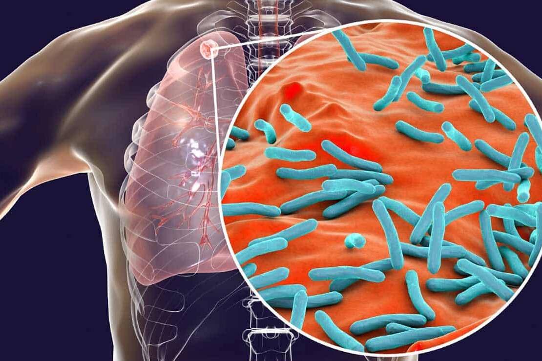 La tuberculose, un fléau persistant à Mayotte malgré la vigilance sanitaire