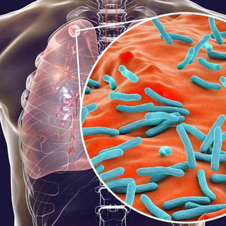 La tuberculose, un fléau persistant à Mayotte malgré la vigilance sanitaire