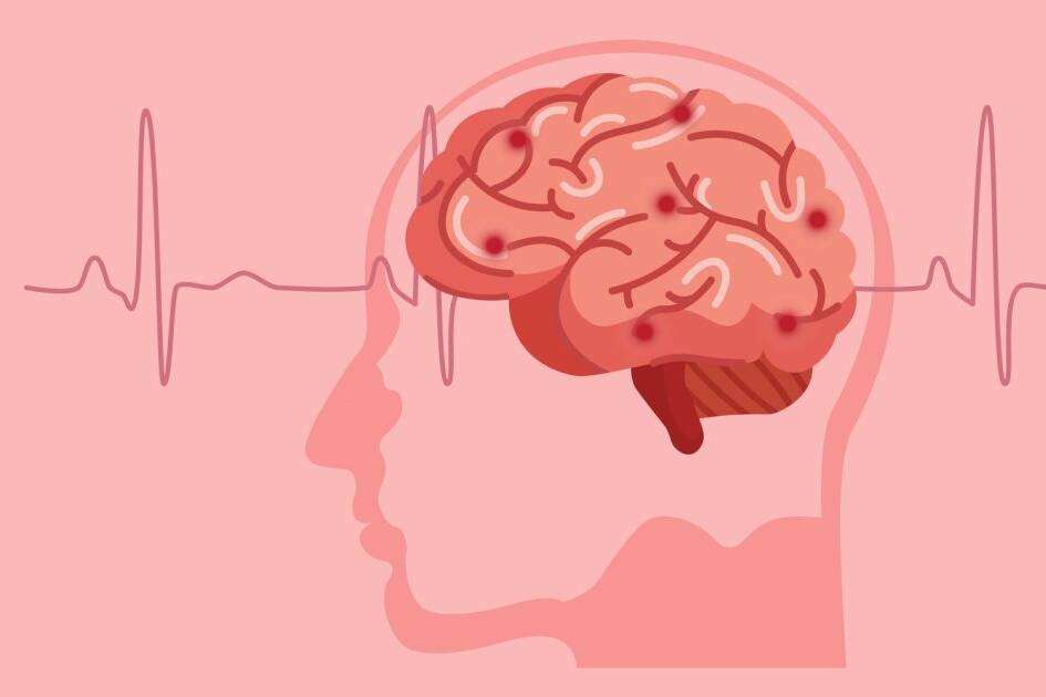 Guadeloupe : une journée pour prévenir l’AVC et sauver des vies