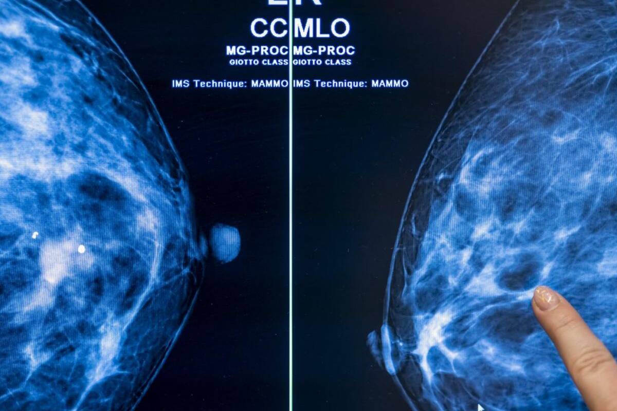 Cancers du sein : disparités entre l’Hexagone et les Outre-mer