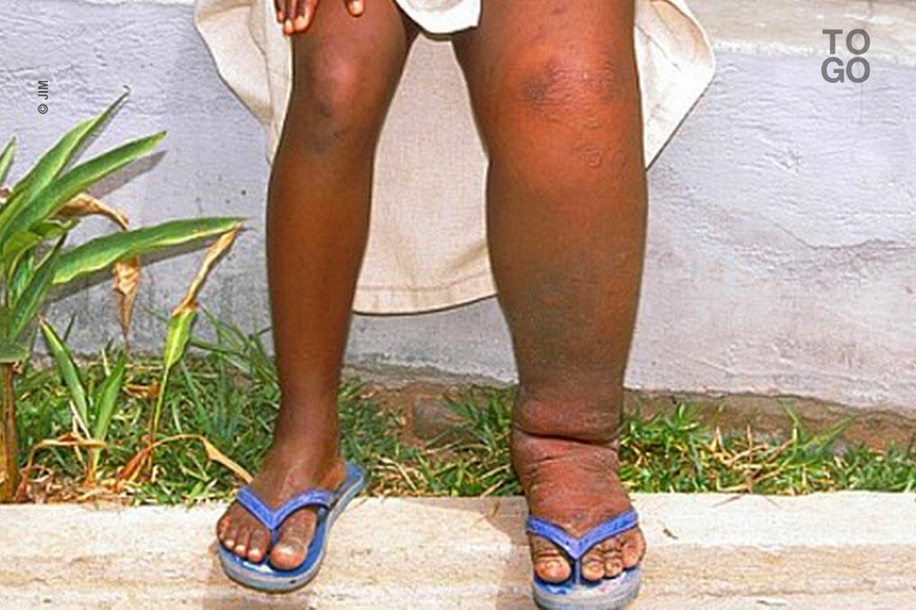 Filariose à Futuna : l’État mobilisé pour reprendre le contrôle sanitaire de l’île