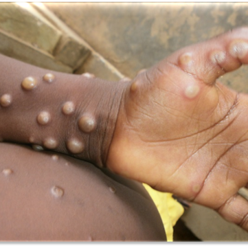 Mayotte : deux nouveaux cas de Mpox, le total monte à trois depuis début janvier