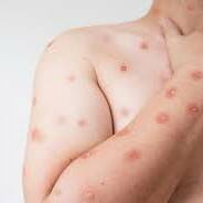 Mpox à La Réunion, l’État assure que le plan d’anticipation est en place après un premier cas