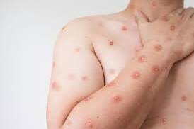 Mpox à La Réunion, l’État assure que le plan d’anticipation est en place après un premier cas