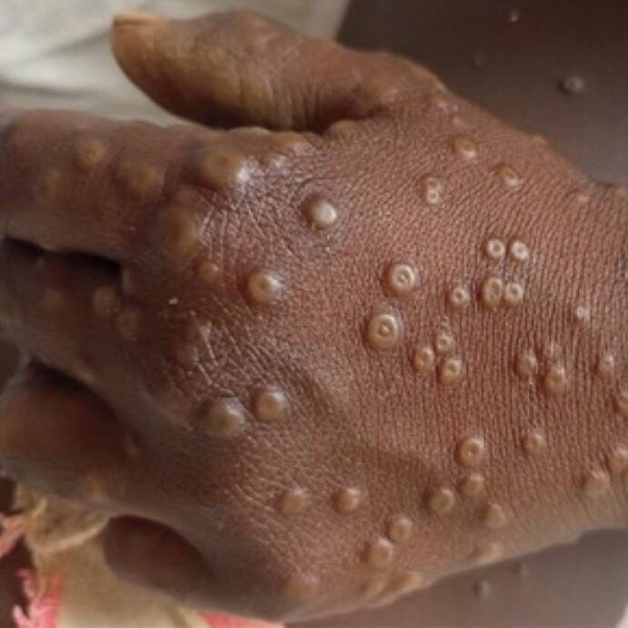 Mayotte : neuf cas de mpox confirmés, l’ARS appelle à la vigilance sans alarmer