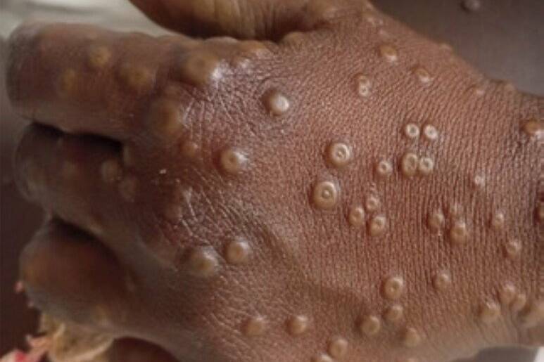 Mayotte : neuf cas de mpox confirmés, l’ARS appelle à la vigilance sans alarmer