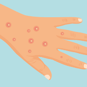 Mayotte : des chaînes de transmission locales de Mpox désormais établies