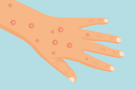 Mayotte : des chaînes de transmission locales de Mpox désormais établies