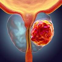 Antilles : de nouveaux traitements ouvrent des perspectives contre le cancer de la prostate